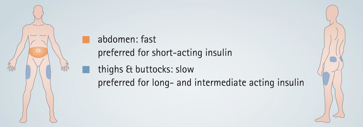 Insulin types and injection areas