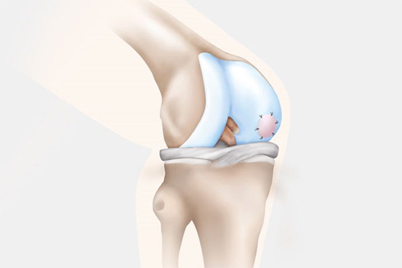 transplant-fixed-sutured