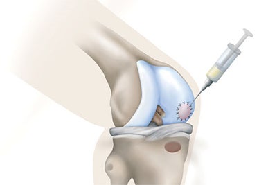 classical-aci-procedures