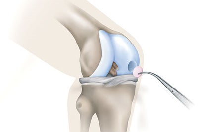 new-generation-aci-procedures