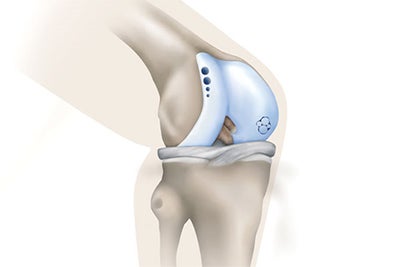 osteochondral-autograft-transplant