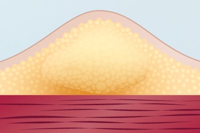 lipohypertrophies 