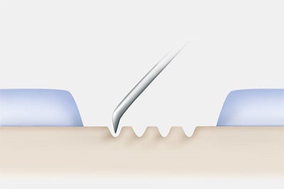 marrow-stimulating-techniques